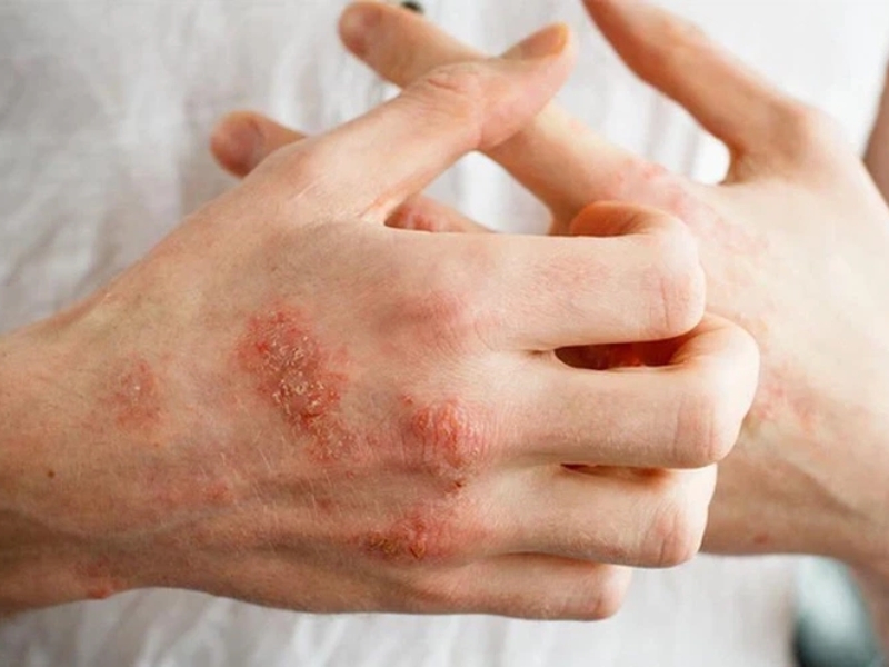 Bệnh này thường gây ngứa, đỏ, và có thể xuất hiện mụn, vảy hoặc lở loét trên da