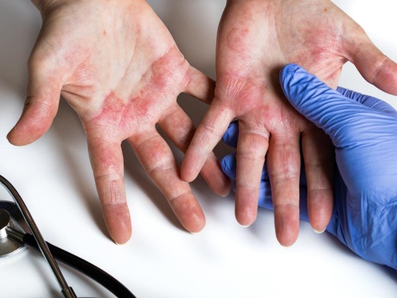 Các triệu chứng của bệnh viêm da cơ địa bàn tay