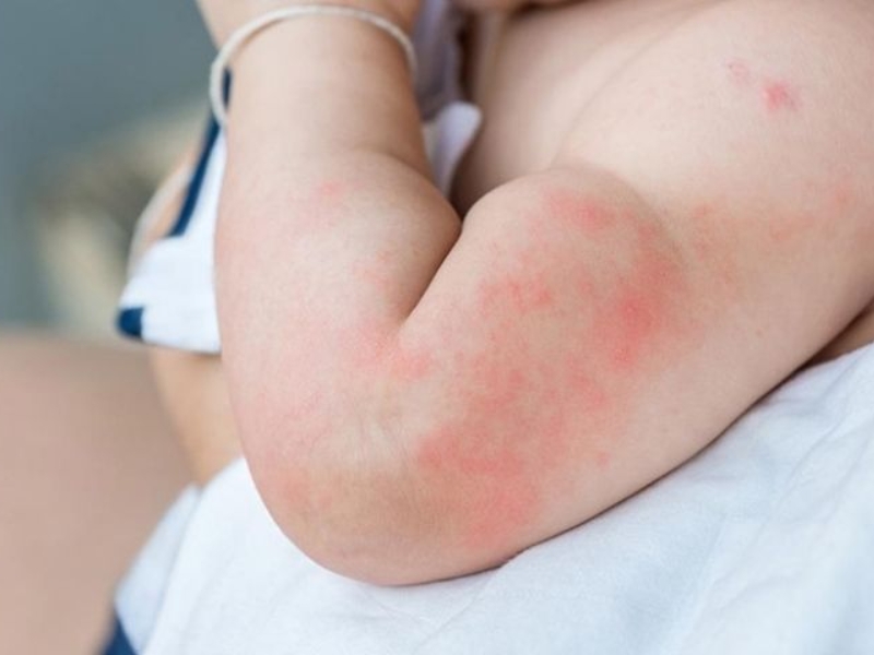 Viêm da tiếp xúc ở trẻ là bệnh gì? Bệnh này có nguy hiểm không?