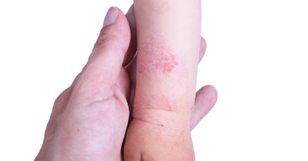 trẻ sơ sinh bị viêm da