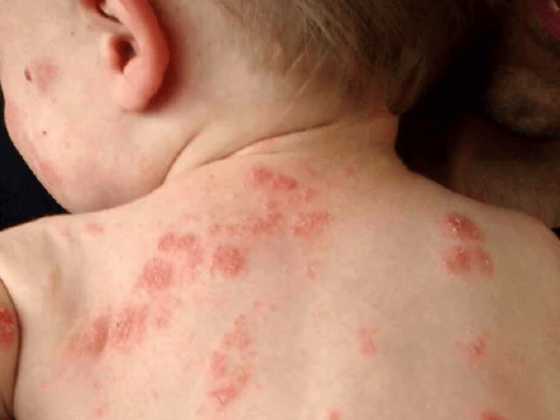 Bệnh viêm da cơ địa là một loại bệnh da liễu mãn tính thường xuyên tái phát