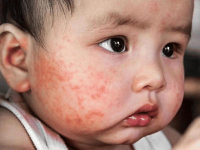 Cách lựa chọn thuốc trị viêm da cơ địa cho bé