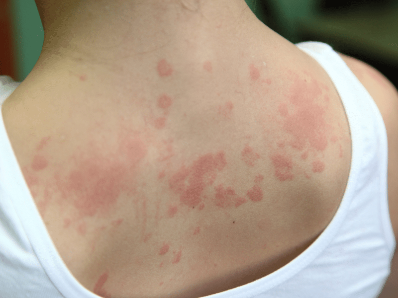 Những triệu chứng viêm da cơ địa ở người trưởng thành