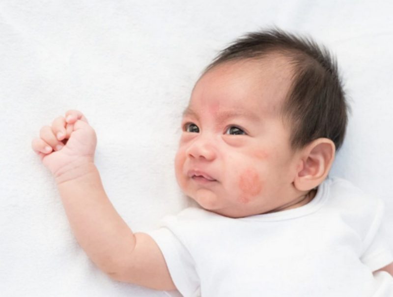 Doi tuong mac benh viem da co dia