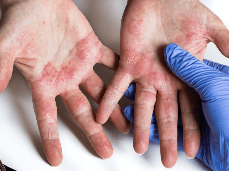 Viêm da cơ địa là một bệnh viêm da mãn tính