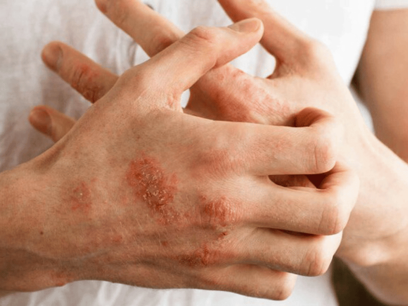 Bệnh viêm da cơ địa là một loại bệnh da liễu mãn tính và tái phát thường xuyên.