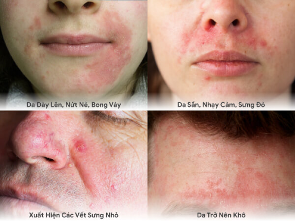 6 triệu chứng viêm da dị ứng