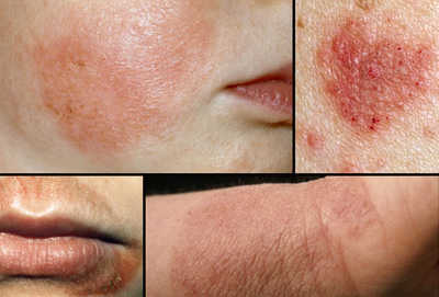 các vùng da bị eczema