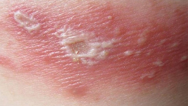 da bị nổi mụn nước trắng đục