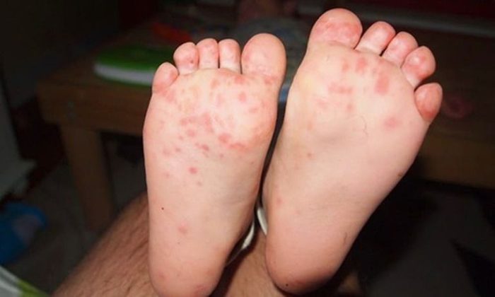lòng bàn chân bị mẩn đỏ
