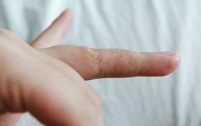 nấm tổ đỉa ở ngón tay