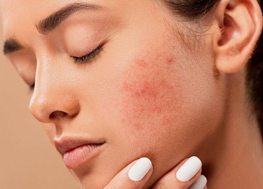 viêm da kích ứng ở vùng má