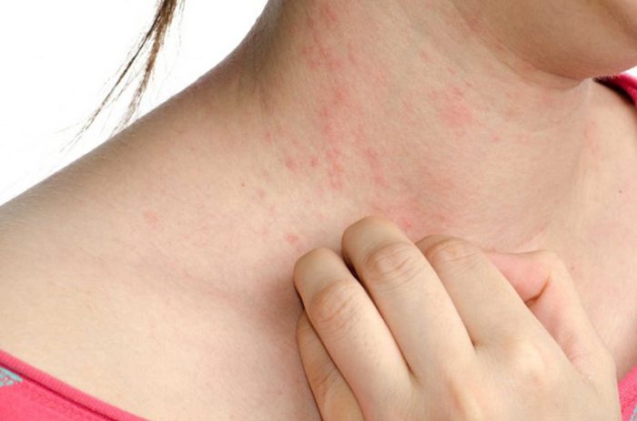 da nổi mẩn đỏ ngứa ở cổ
