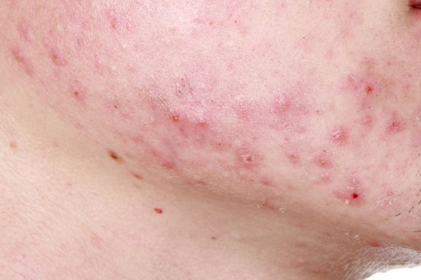 viêm da nổi mụn dày đặc ở mặt