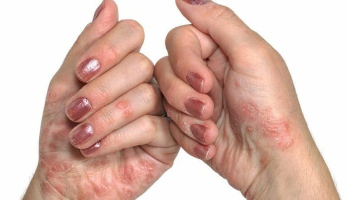 viêm da tổ đỉa ở bàn tay
