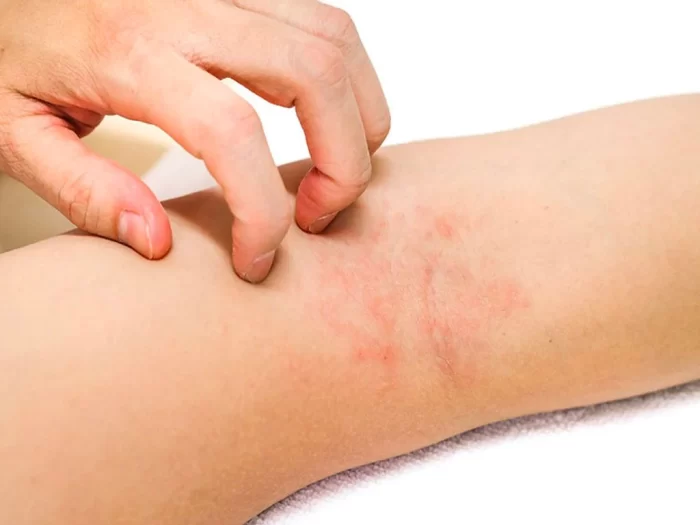 da tay bị bong tróc mẩn ngứa