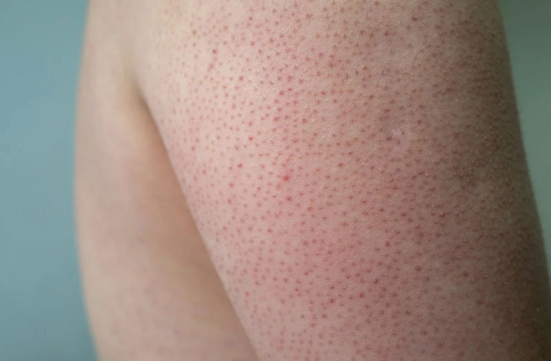 da bị sần mẩn đỏ